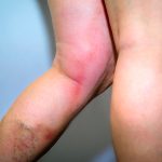 Donna in piedi che manifesta flebite alla gamba, all’altezza del ginocchio, insieme a vene varicose