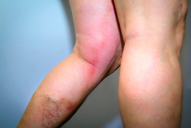 Donna in piedi che manifesta flebite alla gamba, all’altezza del ginocchio, insieme a vene varicose