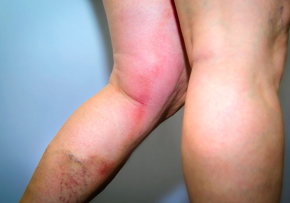 Donna in piedi che manifesta flebite alla gamba, all’altezza del ginocchio, insieme a vene varicose