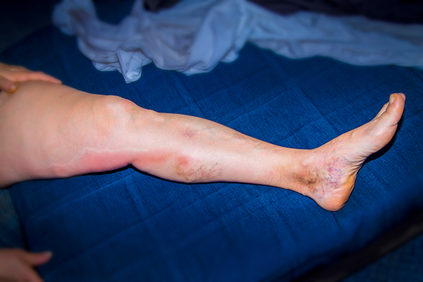 Donna matura che mostra la sua gamba arrossata e gonfia, due sintomi comuni della flebite