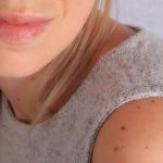 Giovane donna in top che mostra un melanoma nodulare che interessa la zona delle spalle