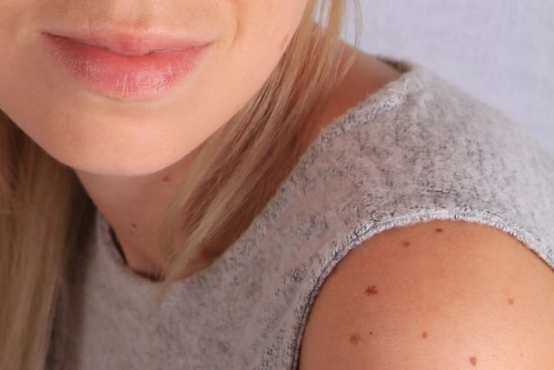 Giovane donna in top che mostra un melanoma nodulare che interessa la zona delle spalle