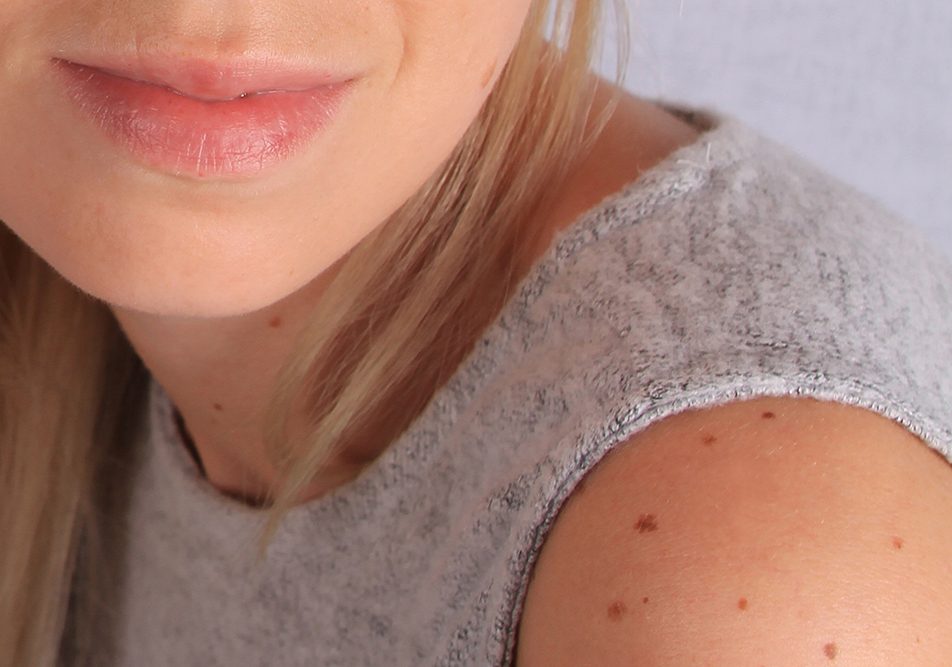 Giovane donna in top che mostra un melanoma nodulare che interessa la zona delle spalle