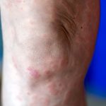 Donna adulta che si prende cura a casa della dermatite atopica che al ginocchio