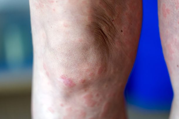 donna-prendendosi-cura-della-dermatite-atopica-al-ginocchio Donna adulta che si prende cura a casa della dermatite atopica che al ginocchio
