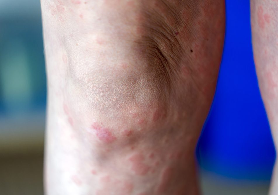 donna-prendendosi-cura-della-dermatite-atopica-al-ginocchio Donna adulta che si prende cura a casa della dermatite atopica che al ginocchio