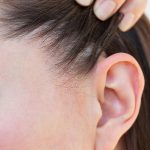 Giovane donna affetta da dermatite seborroica al cuoio capelluto che, con una mano, tiene i capelli dietro al volto