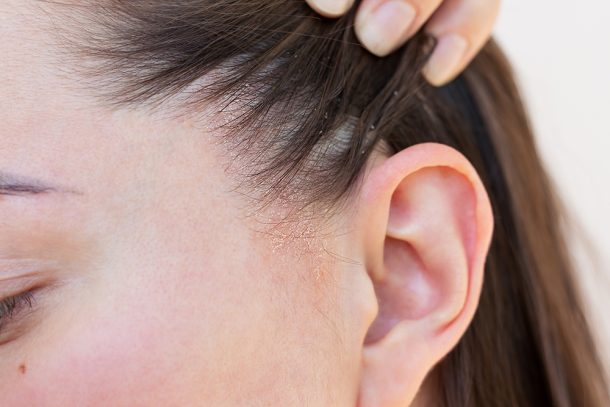Giovane donna affetta da dermatite seborroica al cuoio capelluto che, con una mano, tiene i capelli dietro al volto