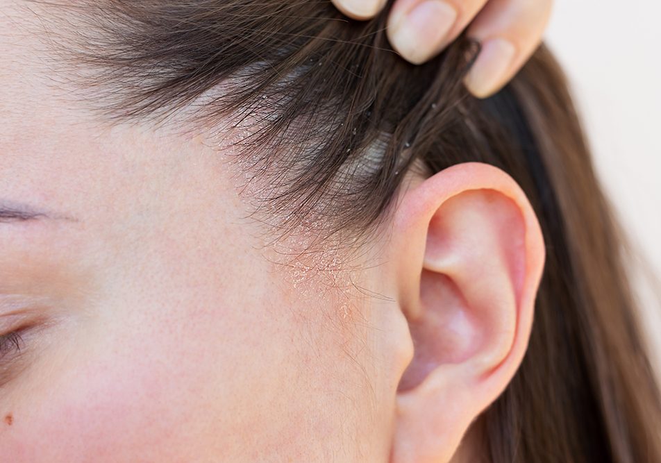 Giovane donna affetta da dermatite seborroica al cuoio capelluto che, con una mano, tiene i capelli dietro al volto