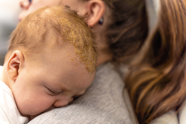 Madre che tiene in braccio il suo neonato che soffre di dermatite seborroica ai capelli, nota come crosta lattea