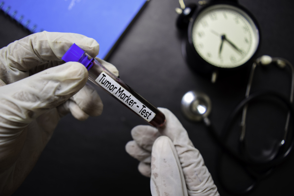 Provetta contenente analisi del sangue marker tumorali, altri test per capire se hai un tumore