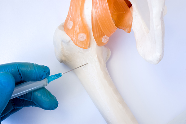 Medico con guanti monouso e ago che mostra una tecnica di analisi del midollo osseo per verificare una possibile neoplasia