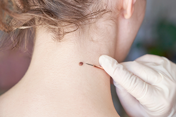 Paziente con un neo sulla nuca che riceve dal dermatologo indicazioni su quando è consigliabile rimuovere i nei