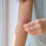 Ragazza che si gratta la pelle arrossata del braccio all’altezza del gomito, evidente segno di dermatite atopica, di cui indaga le cause