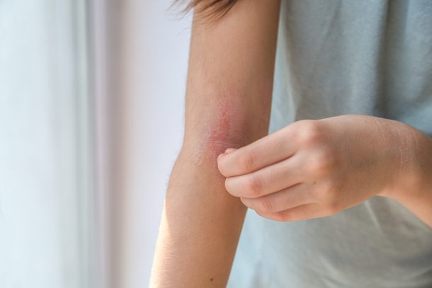 Ragazza che si gratta la pelle arrossata del braccio all’altezza del gomito, evidente segno di dermatite atopica, di cui indaga le cause