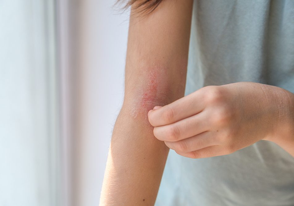 Ragazza che si gratta la pelle arrossata del braccio all’altezza del gomito, evidente segno di dermatite atopica, di cui indaga le cause