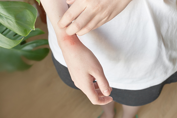 Ragazza in piedi a casa, accanto ad una pianta, che si gratta il polso a causa della dermatite atopica sulle mani di cui è affetta