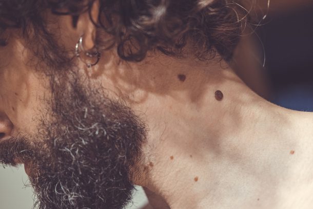 Uomo castano riccio che analizza un neo gonfio comparso sul collo