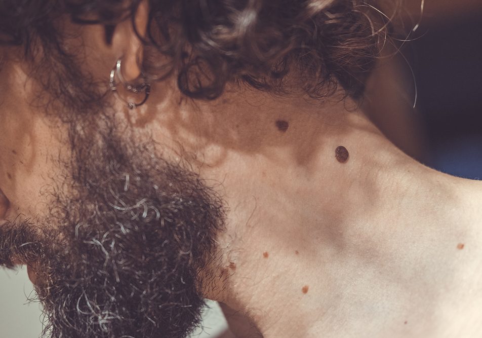 Uomo castano riccio che analizza un neo gonfio comparso sul collo