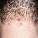 Uomo con eruzione cutanea dermatite erpetiforme
