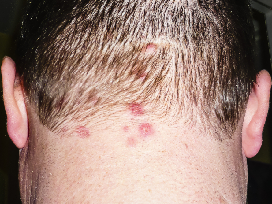 Uomo con eruzione cutanea dermatite erpetiforme