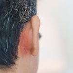 Uomo con dermatite seborroica nella zona del cuoio capelluto accanto al retro delle orecchie