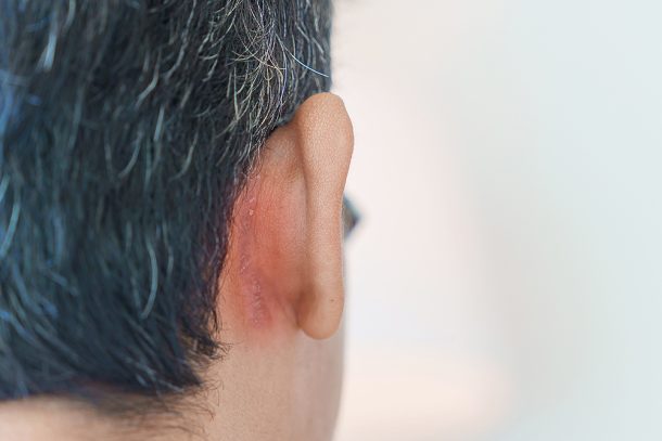 uomo-con-dermatite-seborroica-cuoio-capelluto-accanto-a-orecchie Uomo con dermatite seborroica nella zona del cuoio capelluto accanto al retro delle orecchie