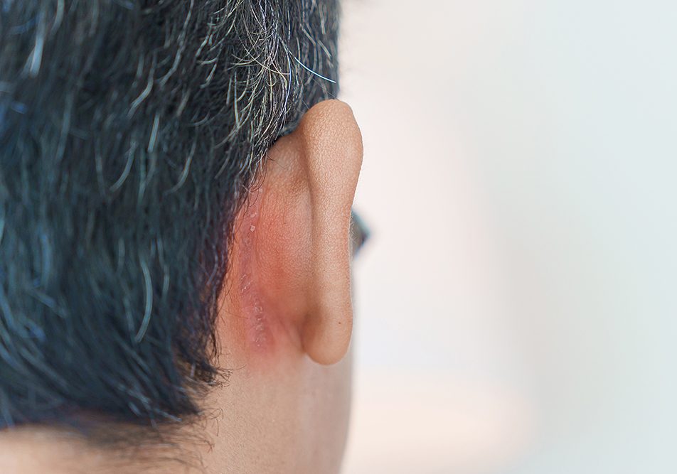 uomo-con-dermatite-seborroica-cuoio-capelluto-accanto-a-orecchie Uomo con dermatite seborroica nella zona del cuoio capelluto accanto al retro delle orecchie