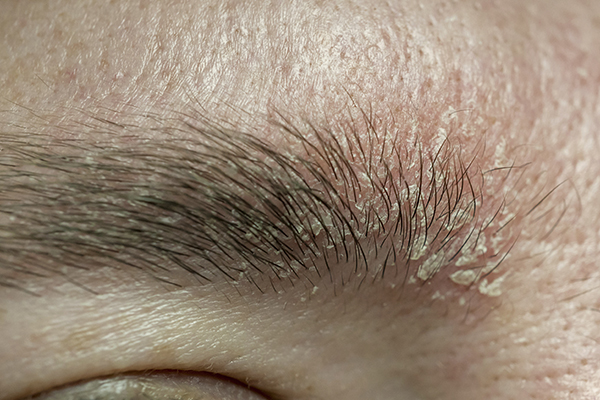 Uomo che soffre di dermatite atopica manifesta delle squame bianche sulla pelle dell’arcata sopraccigliare