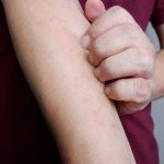Giovane uomo che soffre di prurito al braccio a causa dell’orticaria papulosa di cui è affetto
