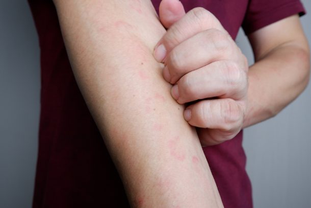 uomo-con-prurito-al-braccio-causato-da-orticaria-papulosa Giovane uomo che soffre di prurito al braccio a causa dell’orticaria papulosa di cui è affetto