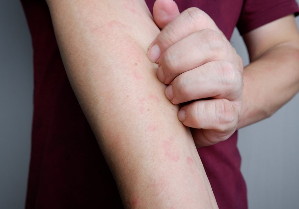 Giovane uomo che soffre di prurito al braccio a causa dell’orticaria papulosa di cui è affetto
