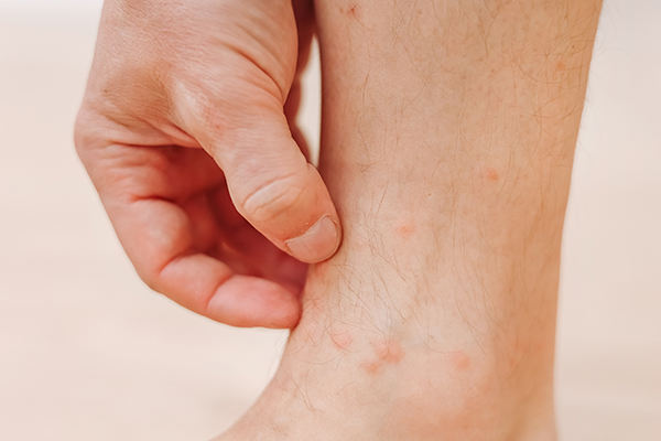 Uomo che si gratta la gamba con dermatite papulosa causata da punture di insetti
