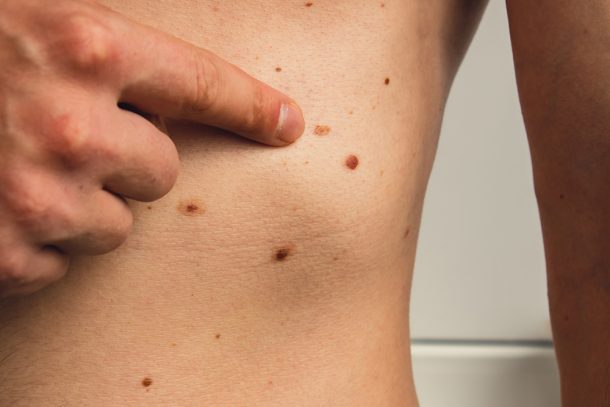 Uomo che indica un possibile melanoma amelanotico comparso nella zona dello stomaco