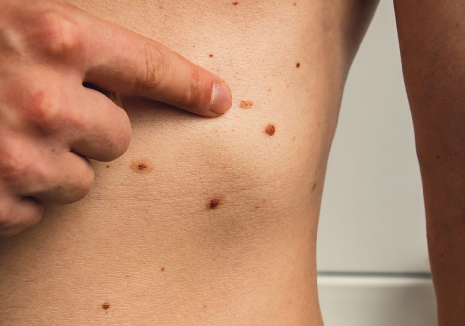 uomo-indicando-possibile-melanoma-amelanotico-nella-zona-dello-stomaco Uomo che indica un possibile melanoma amelanotico comparso nella zona dello stomaco