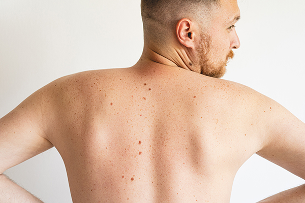 Uomo di spalle che osserva l’aumento improvviso dei nei sulla schiena