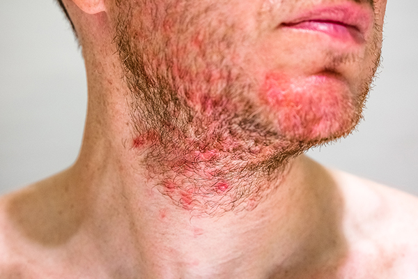 Giovane uomo che soffre di dermatite seborroica nella zona della barba