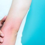 Uomo che si tocca l’avambraccio arrossato e caldo a causa della flebite al braccio di cui è temporaneamente affetto