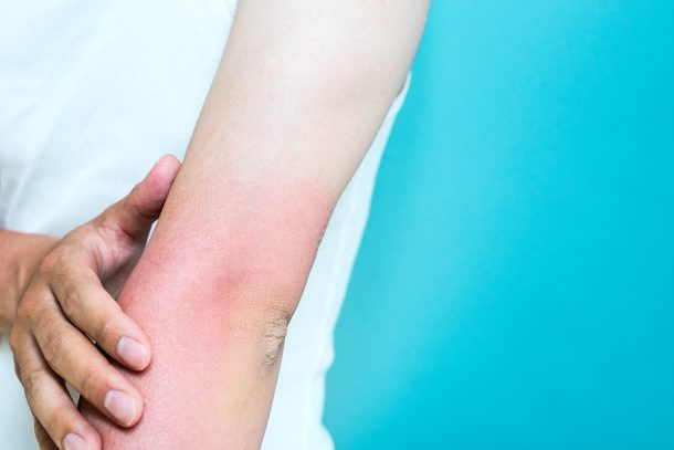 Uomo che si tocca l’avambraccio arrossato e caldo a causa della flebite al braccio di cui è temporaneamente affetto