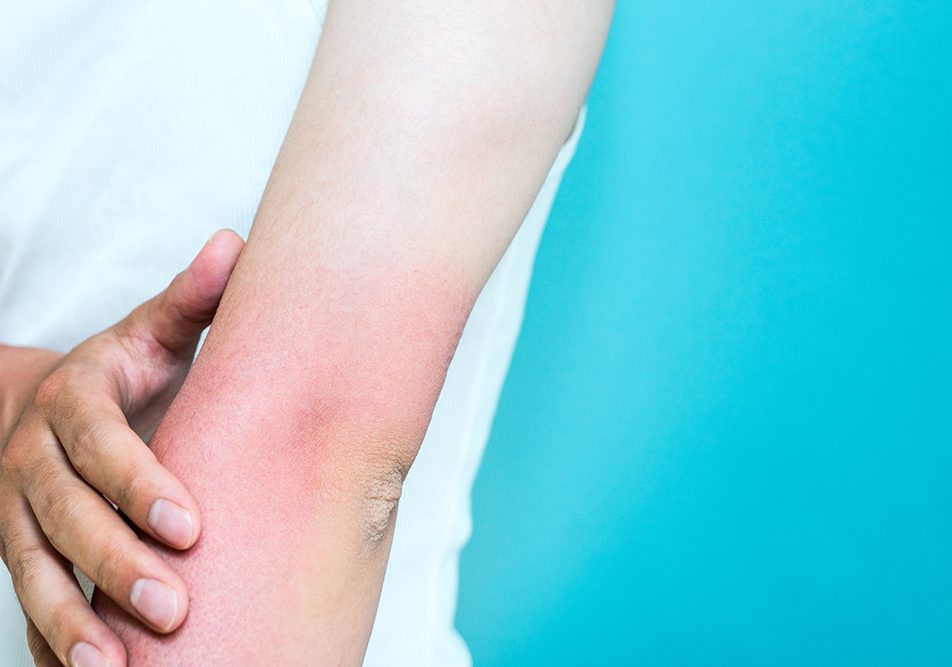uomo-toccandosi-avambraccio-arrossato-e-caldo-a-causa-della-flebite-al-braccio Uomo che si tocca l’avambraccio arrossato e caldo a causa della flebite al braccio di cui è temporaneamente affetto