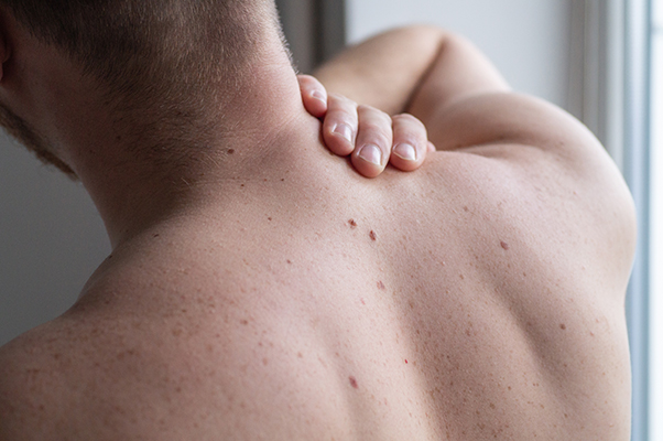 Uomo che cura la salute della sua pelle si tocca i nei sparsi sul dorso, domandandosi in quanto tempo può degenerare un melanoma