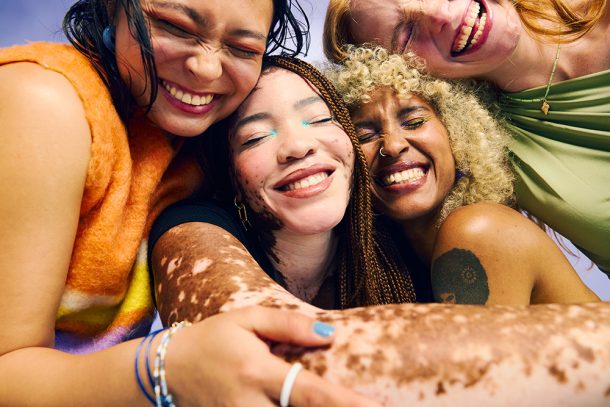 ragazze-abbracciandosi-accomunate-da-vitiligine-cura Ragazze allegre che si abbracciano convivono con una situazione di salute comune essendo in cura dalla vitiligine