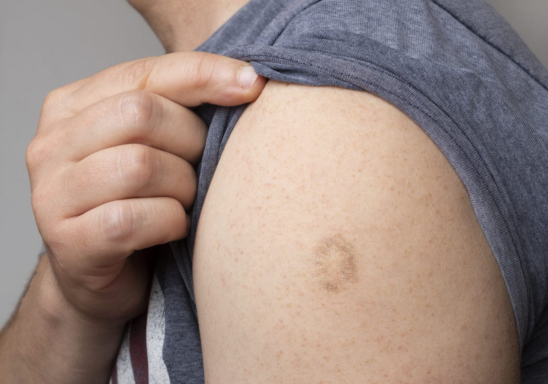 uomo mostra segno vaccino vaiolo sulla spalla