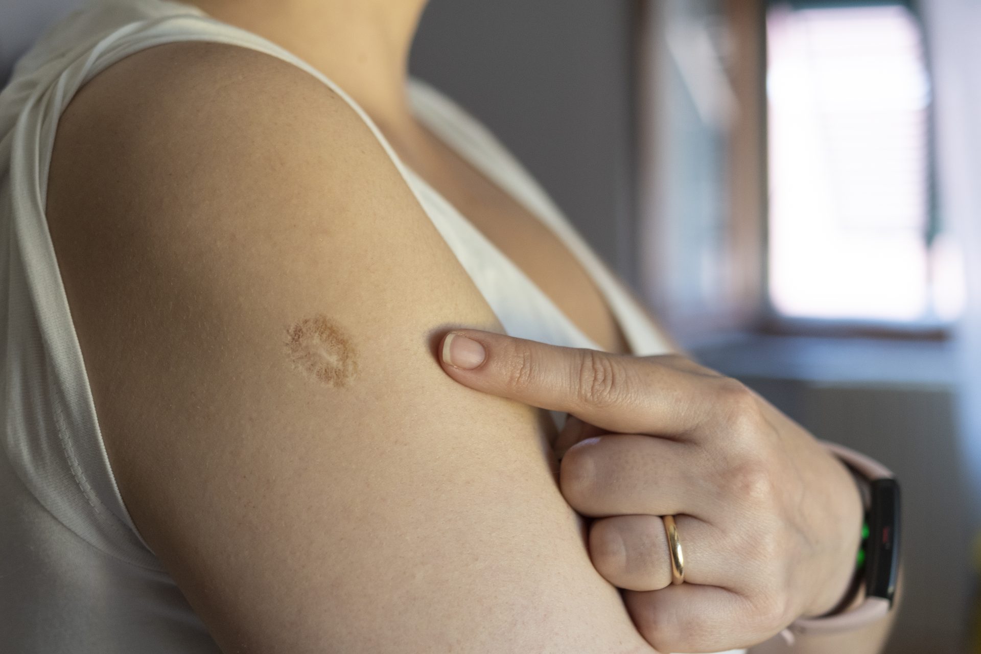 donna indica segno del vaccino sul braccio