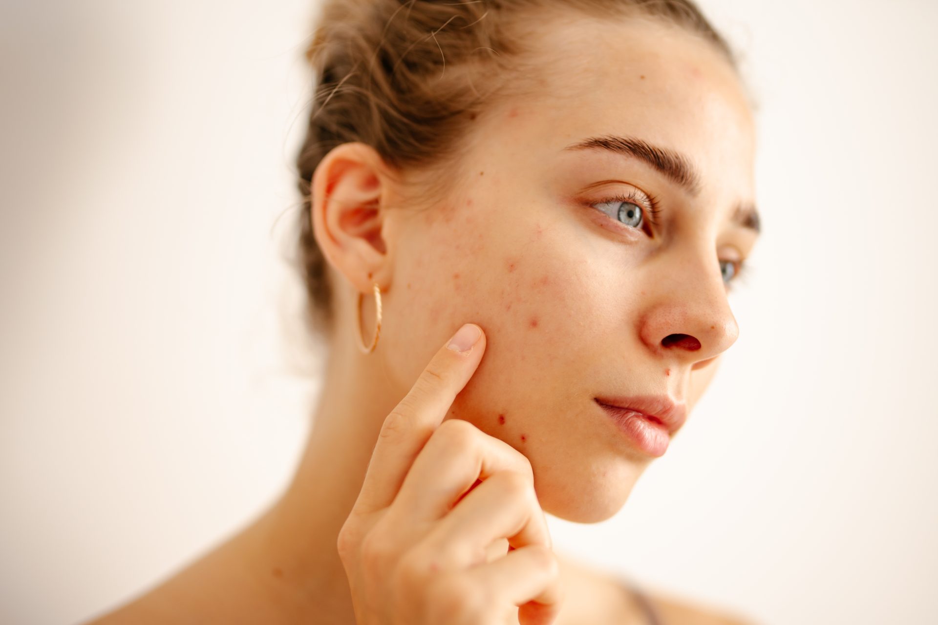 ragazza con acne sul volto