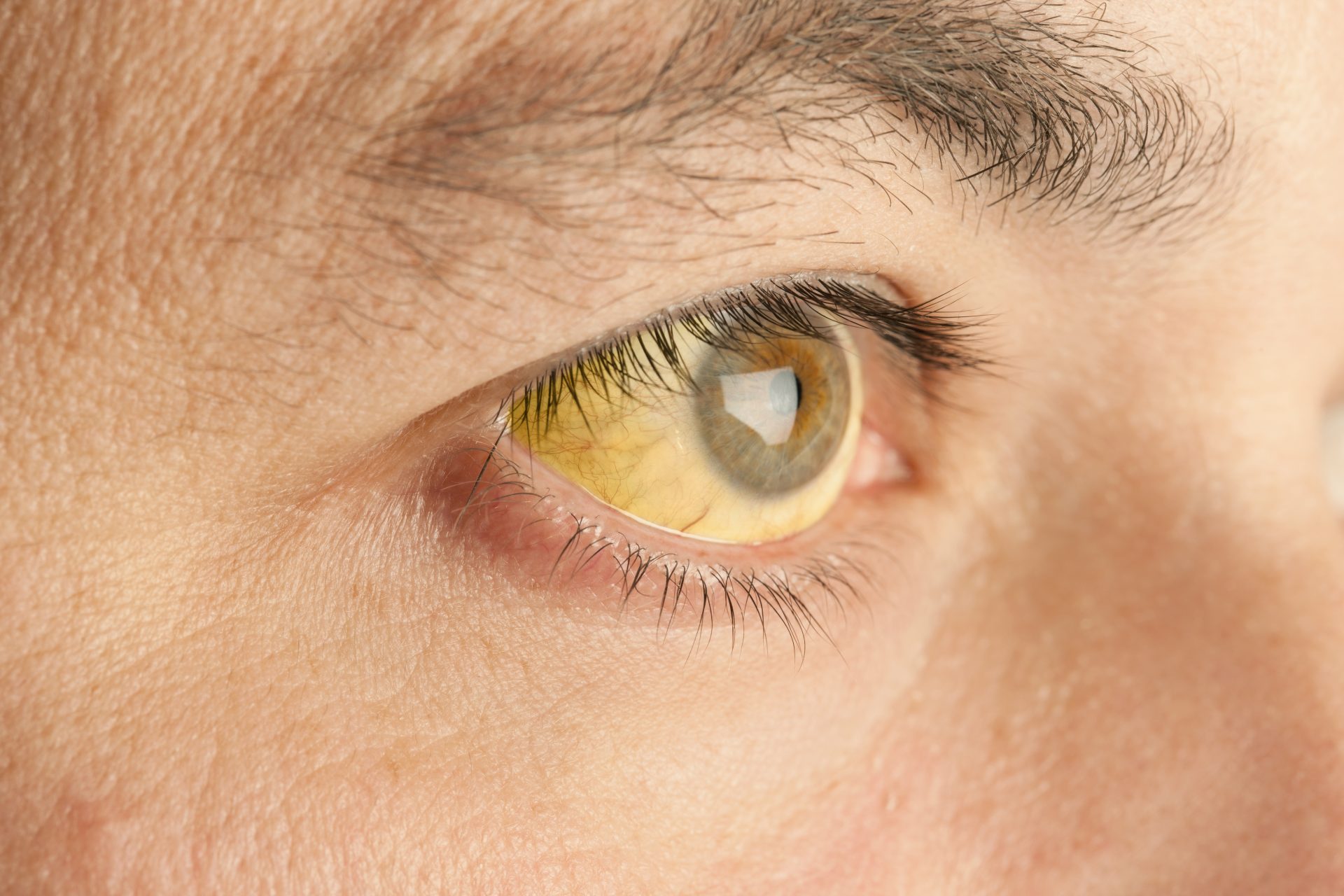 occhio con sclera di colore giallo causata da ittero