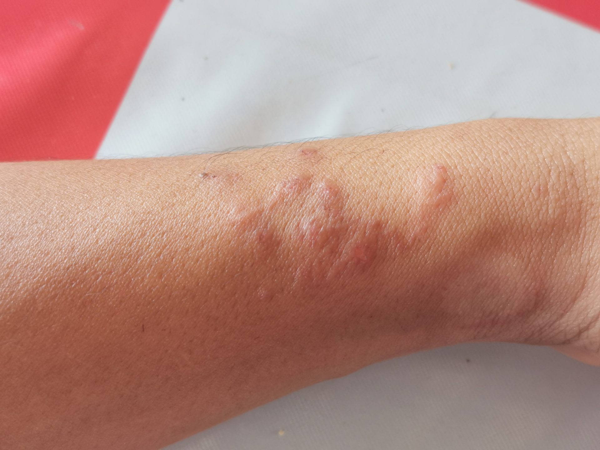lesione da larva migrans su braccio