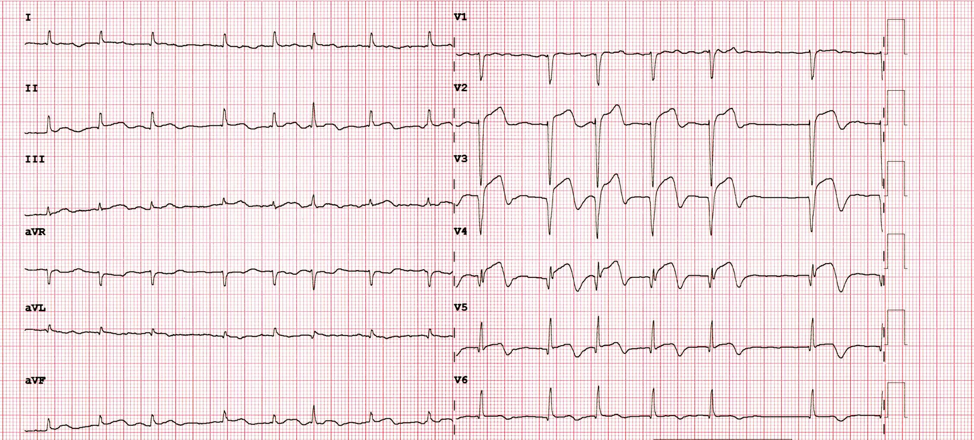 ecg tachicardia ventricolare