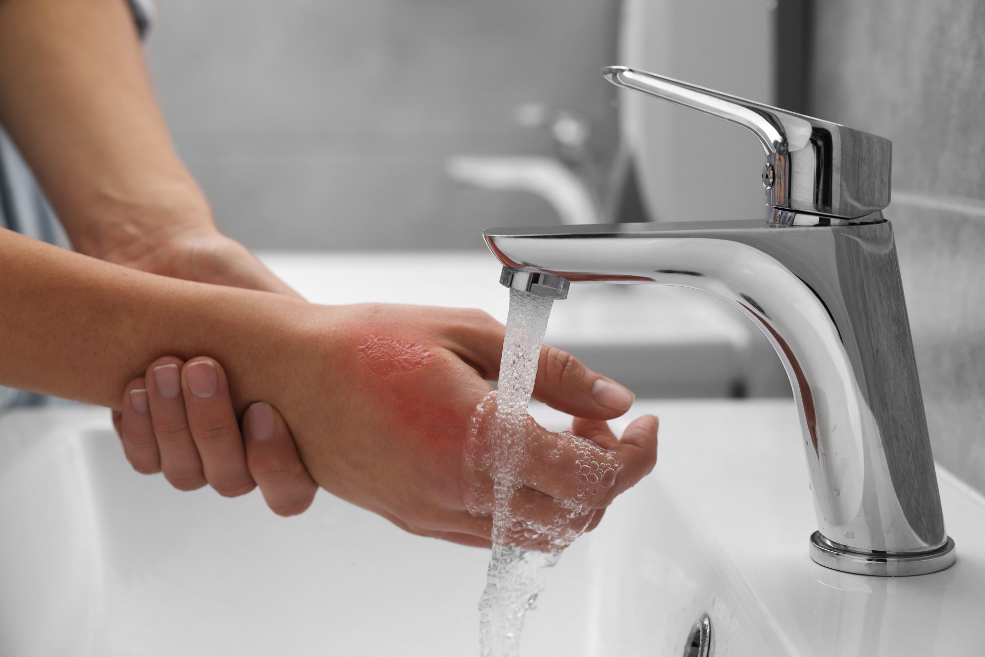 mano ustionata sotto l'acqua del rubinetto