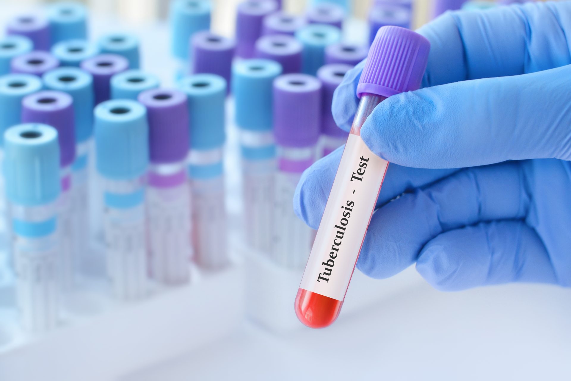 test tubercolosi